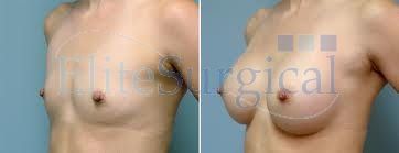 breast enlargement surgery (after and before)