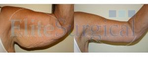 Before and after-arm lift surgery UK