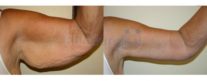 Before and after-arm lift surgery UK
