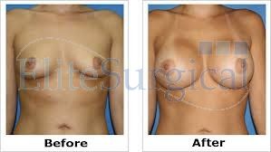breast enlargement surgery (before and after )