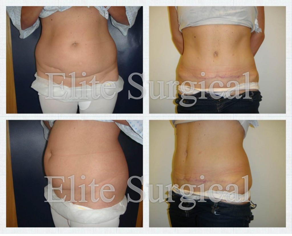 Tummy tuck surgery (Abdominoplasty), London, Birmingham, Cardiff, UK