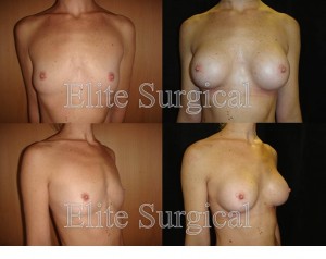 Case study breast implants birmingham, UK