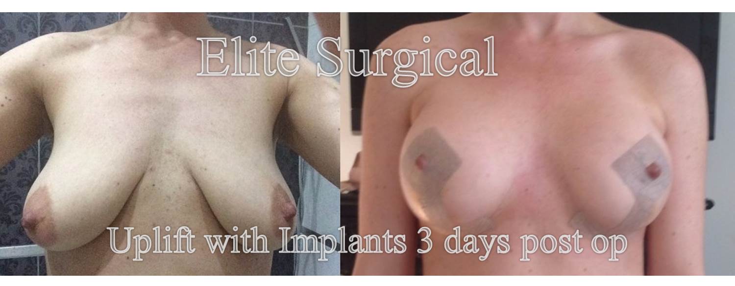 breast implants birmingham, UK