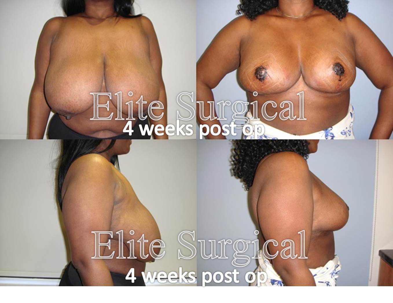 breast augmentation birmingham uk
