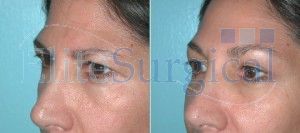 brow lift surgery