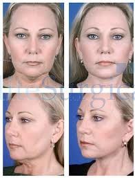 after effects -facelift transformation