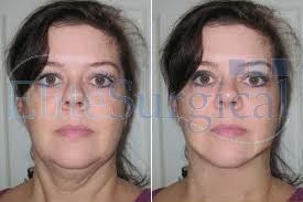 Get the best neck lift surgery (2) in uk