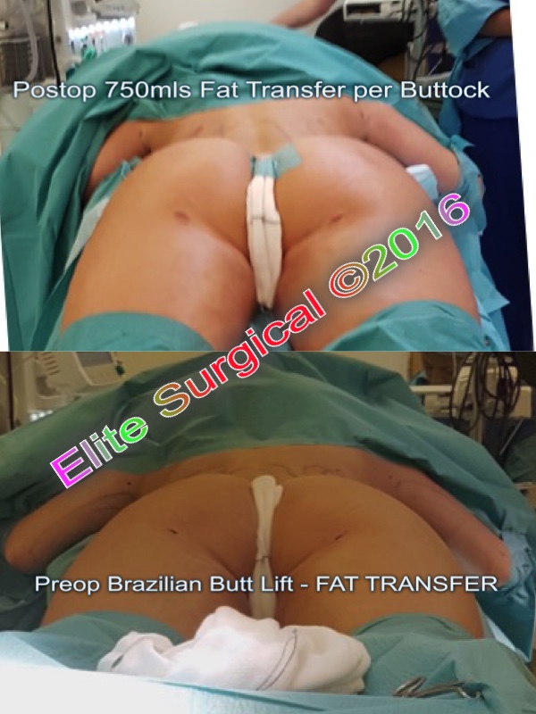fat transfer to buttocks uk