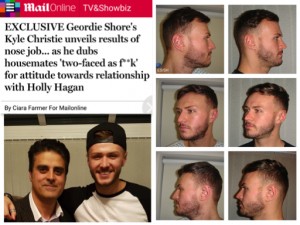 Kyle Christie reveals the results of his Rhinoplasty/Nose Job by Dr Sultan Hassan of Elite Surgical