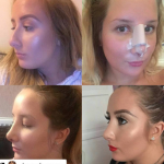 Rhinoplasty - Elite Surgical - pre and postop results