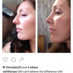 Rhinoplasty - Elite Surgical - pre and postop results